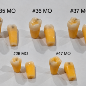 Caries Tooth MO Connected – Compatible with ADC Columbia-Style Models